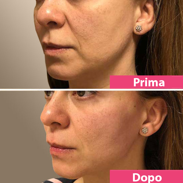 Filo proteico lifting istantaneo per il viso